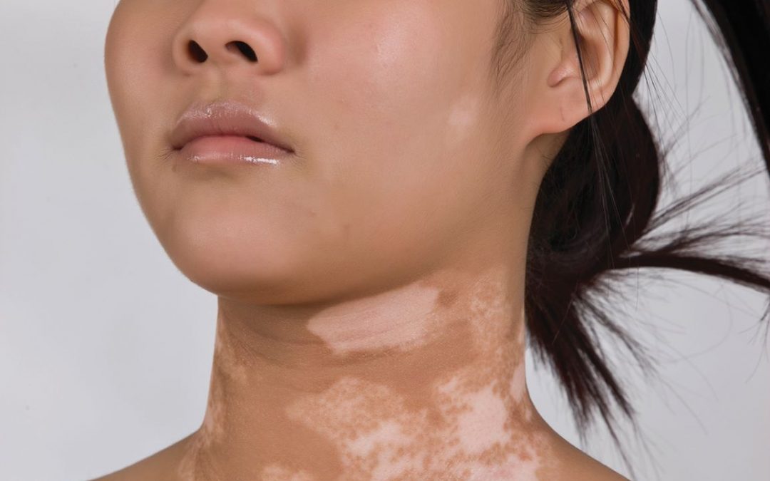 Vitiligo and Stress: Understanding the Connection
