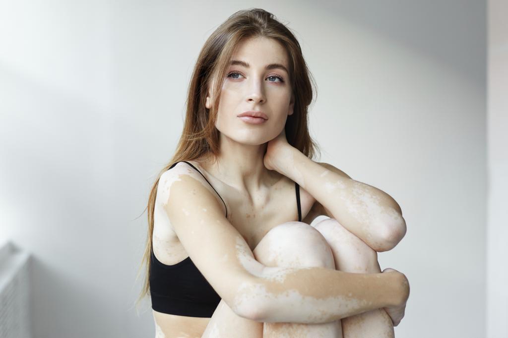 What is Vitiligo? Causes, Treatments and Impact on Lives - Colourderma 2021