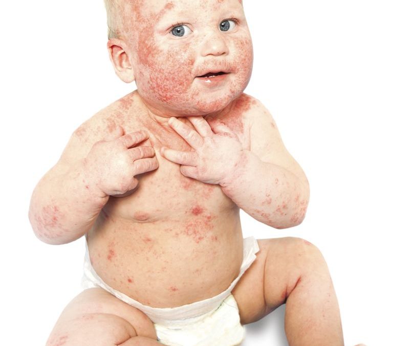 What is Eczema?