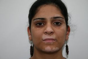 Can vitiligo be stopped from spreading? - Colourderma 2021 Before