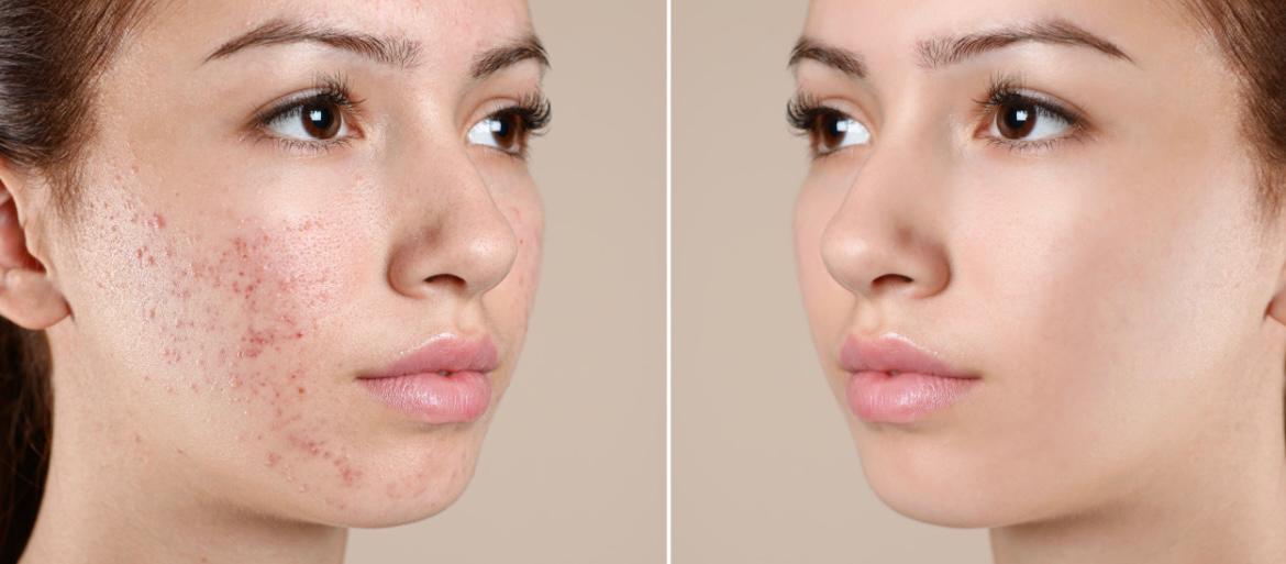 Acne Scarring